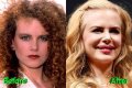 Nicole Kidman's "Lioness" Plastic Surgery: Uncovering Hidden Truths